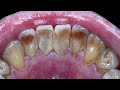 37 yo. Male&#39;s Teeth | Scaling | Karang Gigi | Tartar | Dentist | Dokter Gigi Tri Putra
