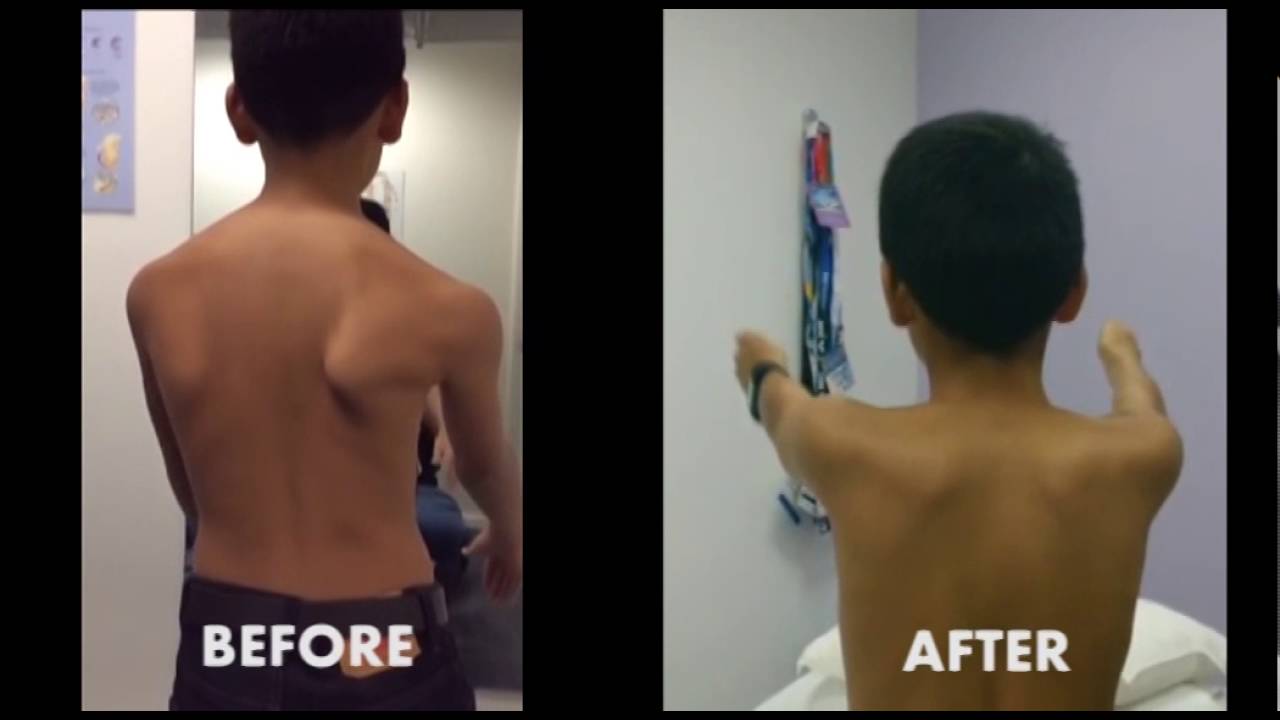 Humero-scapular position and motion fault before and after the corrective exercises program