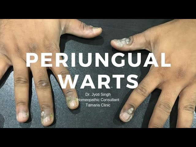 Periungual Warts Youtube