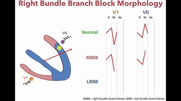 Left Bundle Branch Block and Right Bundle Bundle Branch Morphology