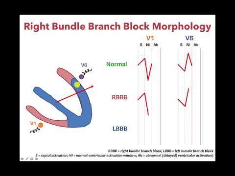 left-bundle-branch-block-and-right-bundle-bundle-branch-morphology