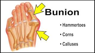 Bunions; Bunion Treatment &amp; Surgery. Doylestown Podiatrist