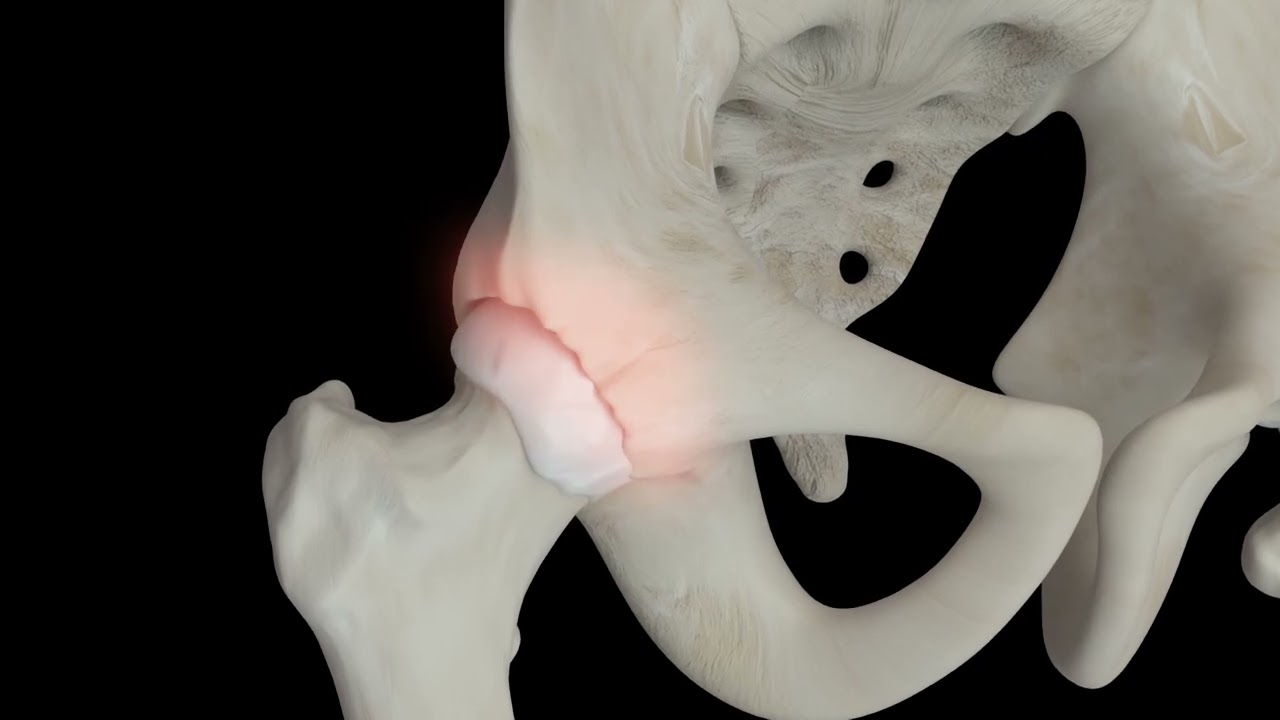 人工股関節全置換術について - YouTube