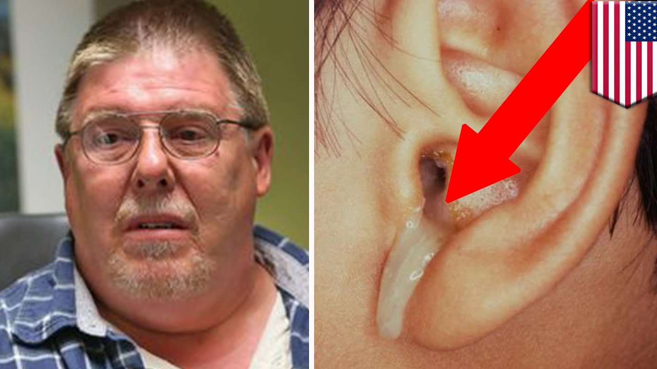 Brain leak: Man finds liquid seeping out of his ear 