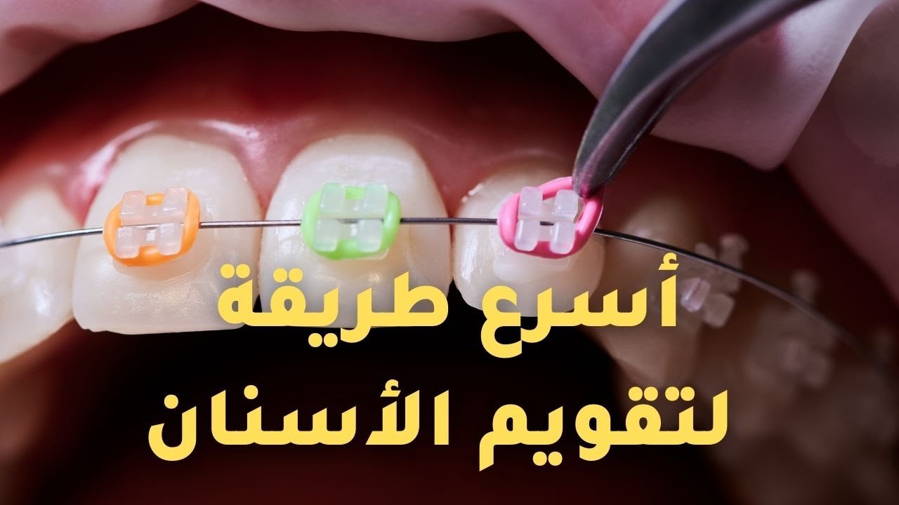تقويم الأسنان طريقة تركيب تقويم الأسنان How dentist put Braces on teeth