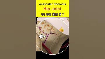 Avascular necrosis of Hip #shorts #medicalstudent  #necrosis