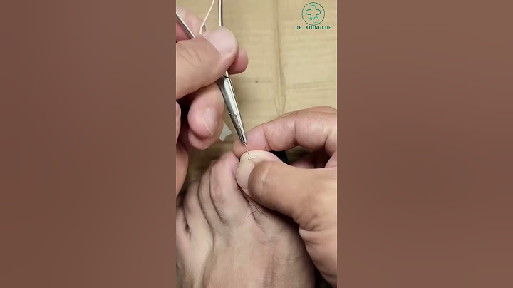 Best Way to Prevent Ingrown Toenails #shorts #shortsfeed #toenails