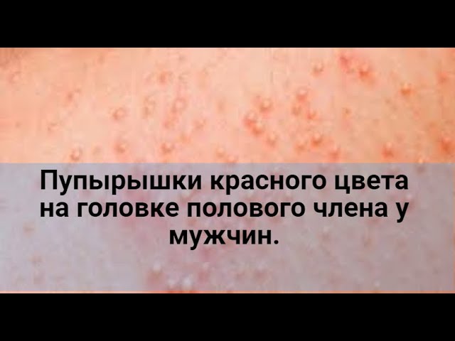 Пупырышки красного цвета на головке полового члена.