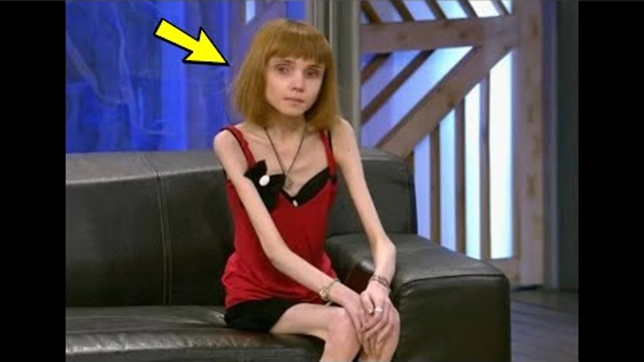 Помните девушку, которая весила 17 кг  Вы будете ошарашены, вот что с ней стало!