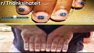 r/TIHI | finger braces??