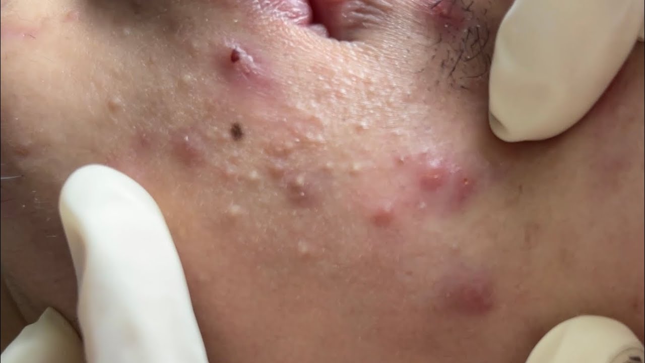 Acne treatment under the skin - p1