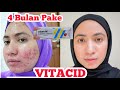 Hilangkan Bekas Jerawat Bandel dengan Vitacid!