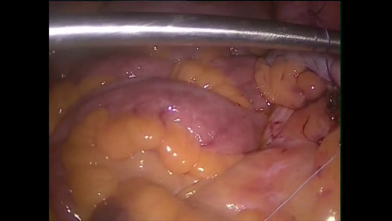 Laparoscopic appendectomy YouTube