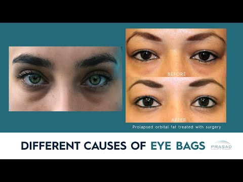 What Causes Bags Under Eyes?