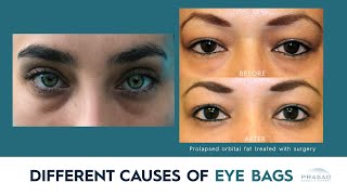 What Causes Bags Under Eyes?