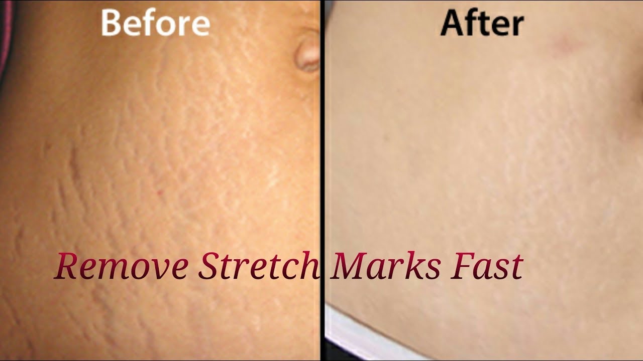 Убрать старые растяжки с живота быстро