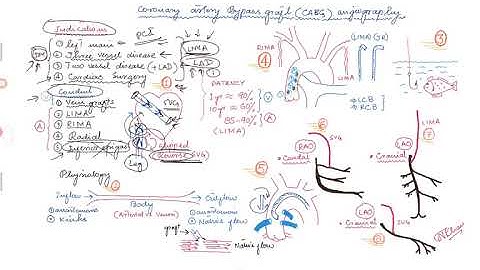 Coronary Angiogram for Bypass Graft (CABG)