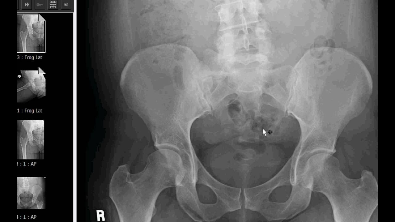 X ray search. Рентген кисти руки. Linkedin save feature. Нормальный тазобедренный сустав рентген. Рентгеновское изображение.