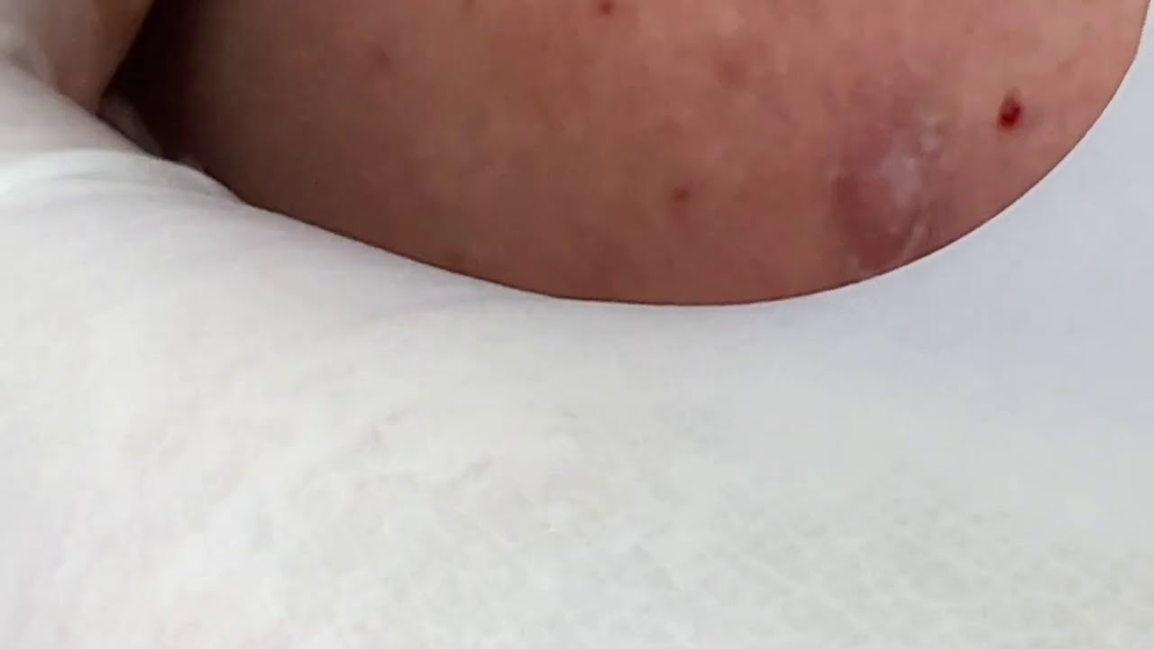 How To Get Rid Of Acne Under The Skin | Làm Sạch Mụn Ẩn Dưới Da - SacDepSpa#234