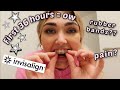 My first 36 Hours with Invisalign braces!! Rubber bands, Pain and cleaning my trays!