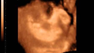 Ultrasonido Yuridia Valenzuela