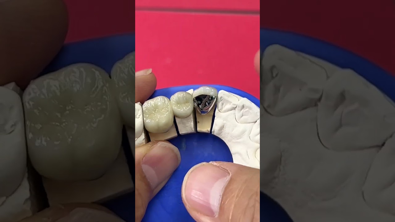 Replaced old metal ceramics!