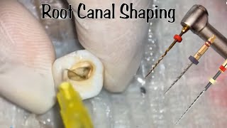 Root Canal Shaping using rotary files