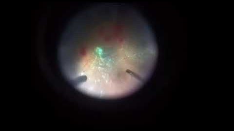 Inverted ILM peeling in a clover leaf pattern to close a macular hole