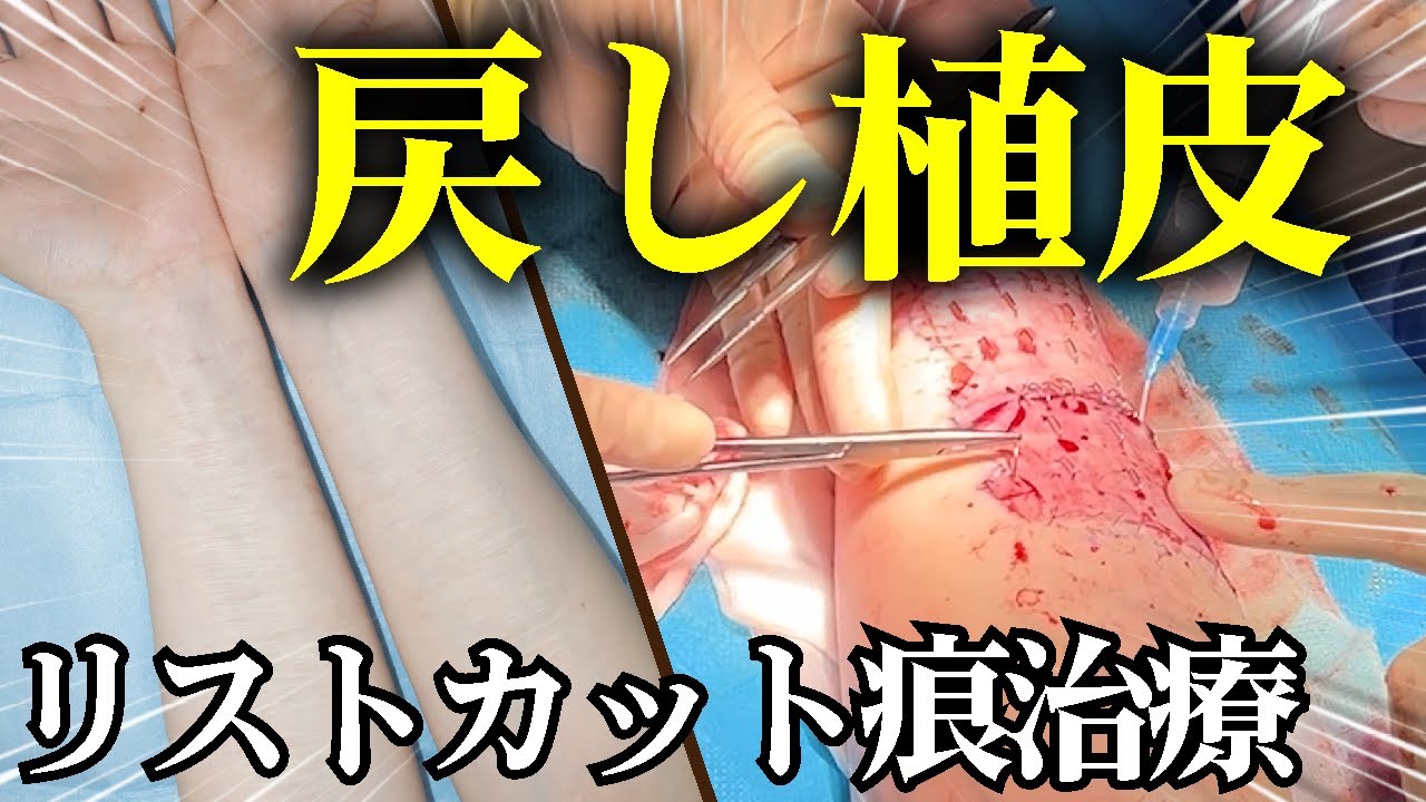 リスト カット 治療