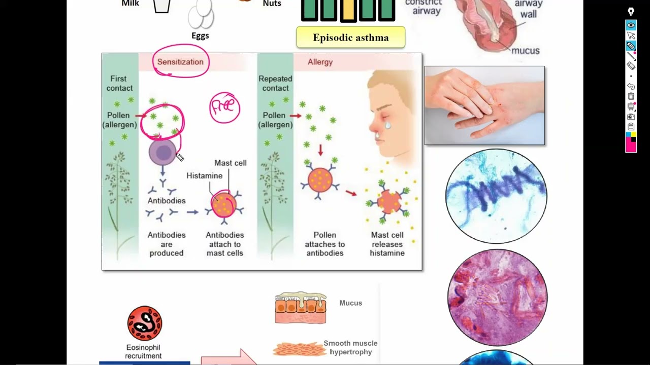 5-Bronchial asthma & Mediastinal syndrome شرح باطنة دكتور سويلم