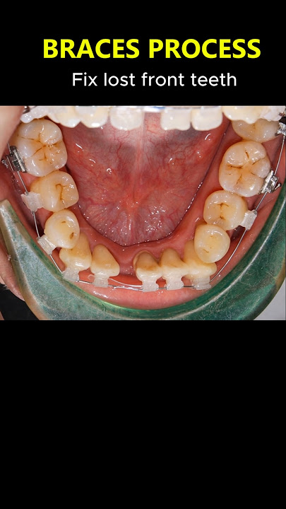 Amazing braces. Fix lost front teeth #braces #orthodontist #dentist #teeth