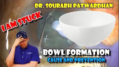 67 Bowl formation : Cause and prevention Dr Sourabh Patwardhan - Soft cataract