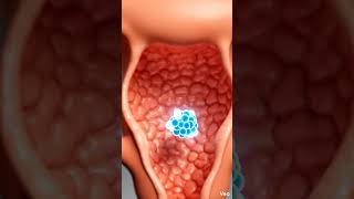 🧬 IUI vs IVF vs ICSI – What’s the Difference? #femaleinfertility #modernfertility #ivf