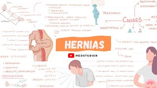 What are hernias? | Direct and Indirect | MedStudier