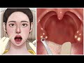 [ASMR] 입냄새의 원인! 편도결석 제거 애니메이션 / Cause of bad breath! Tonsil stone removal animation