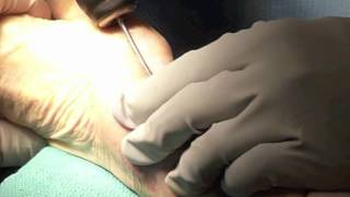 T-Pin Operative Technique.mov