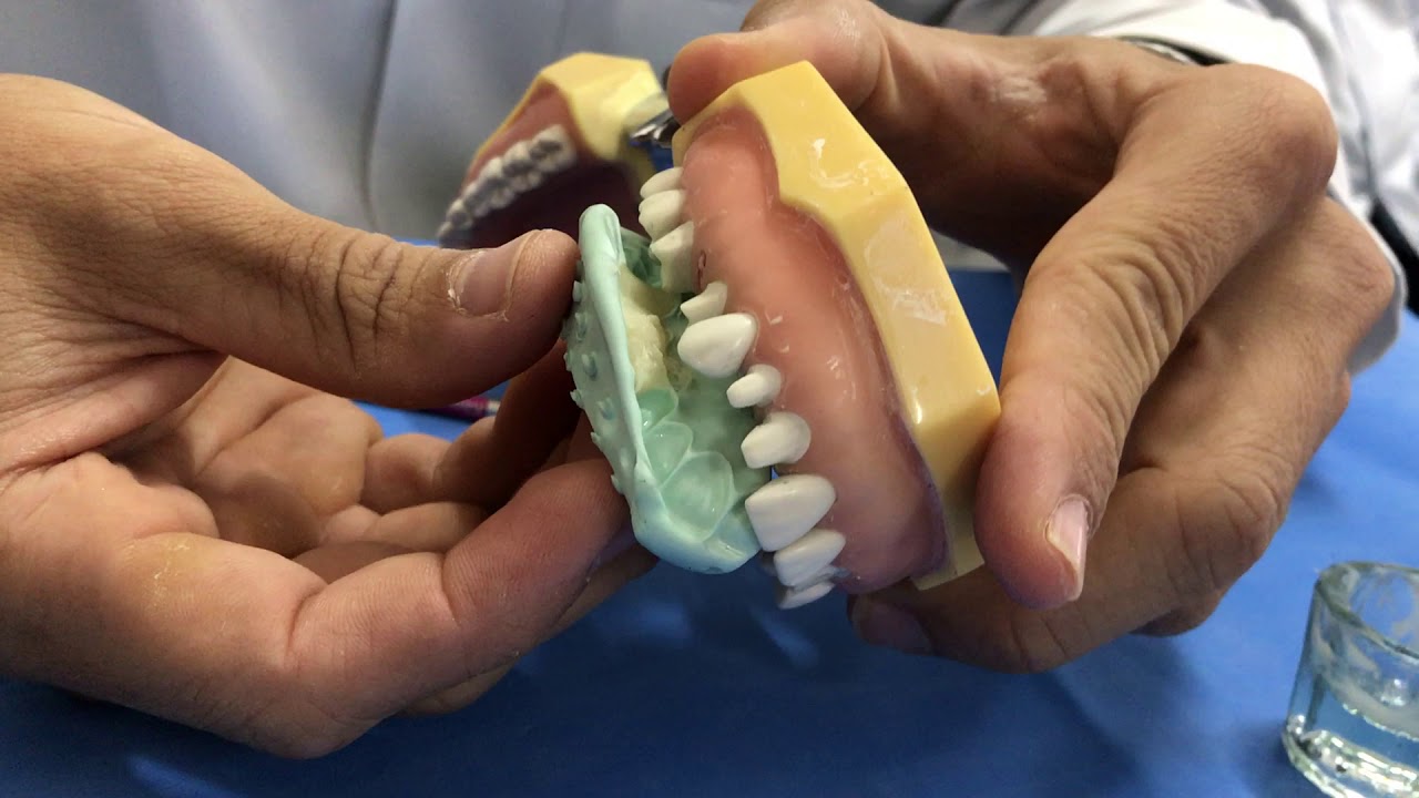 PARTE 1 CONFECÇÃO DE PROVISÓRIO PELA TÉCNICA DA PRÉ MOLDAGEM