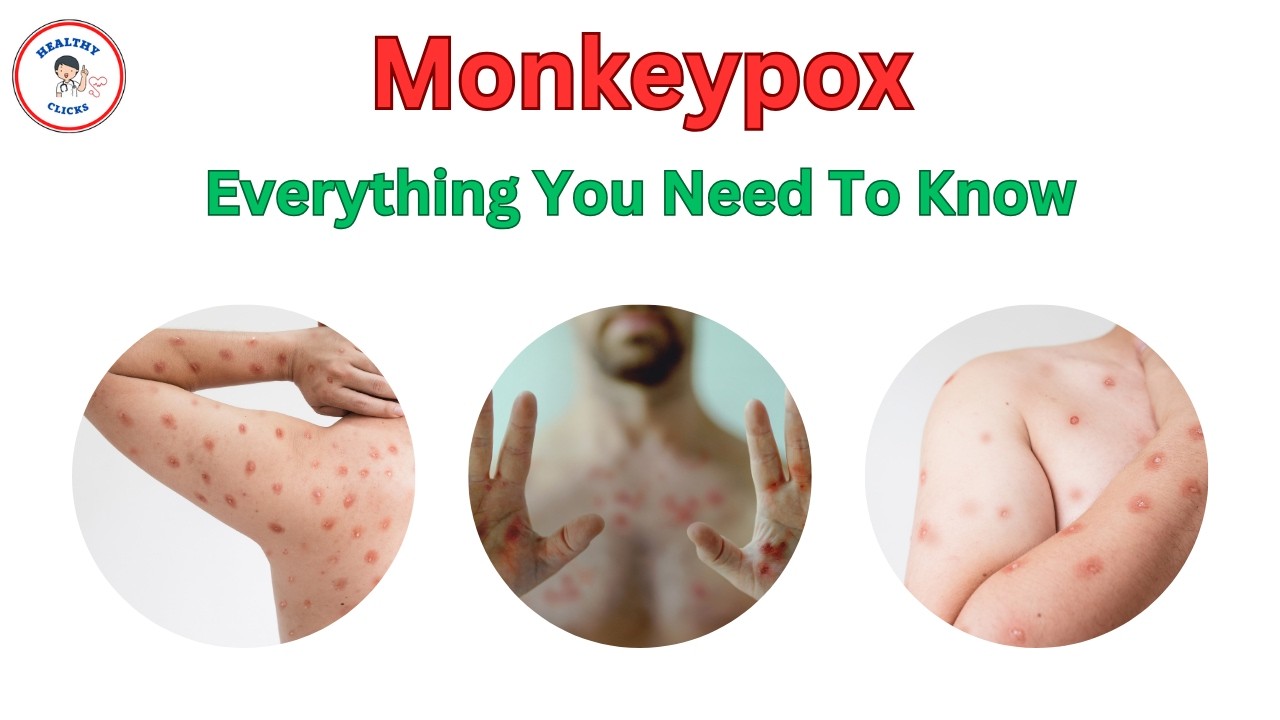 Crucial Facts About Monkeypox You Need to Know Now - YouTube