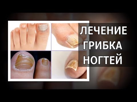 TREATMENT of FUNGUS TOENAILS / Penny Method