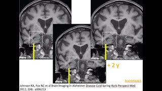 18. Alzheimer dementia on MRI; neurodegenerative, hippocampus, atrophy, MTA grading, MRI imaging
