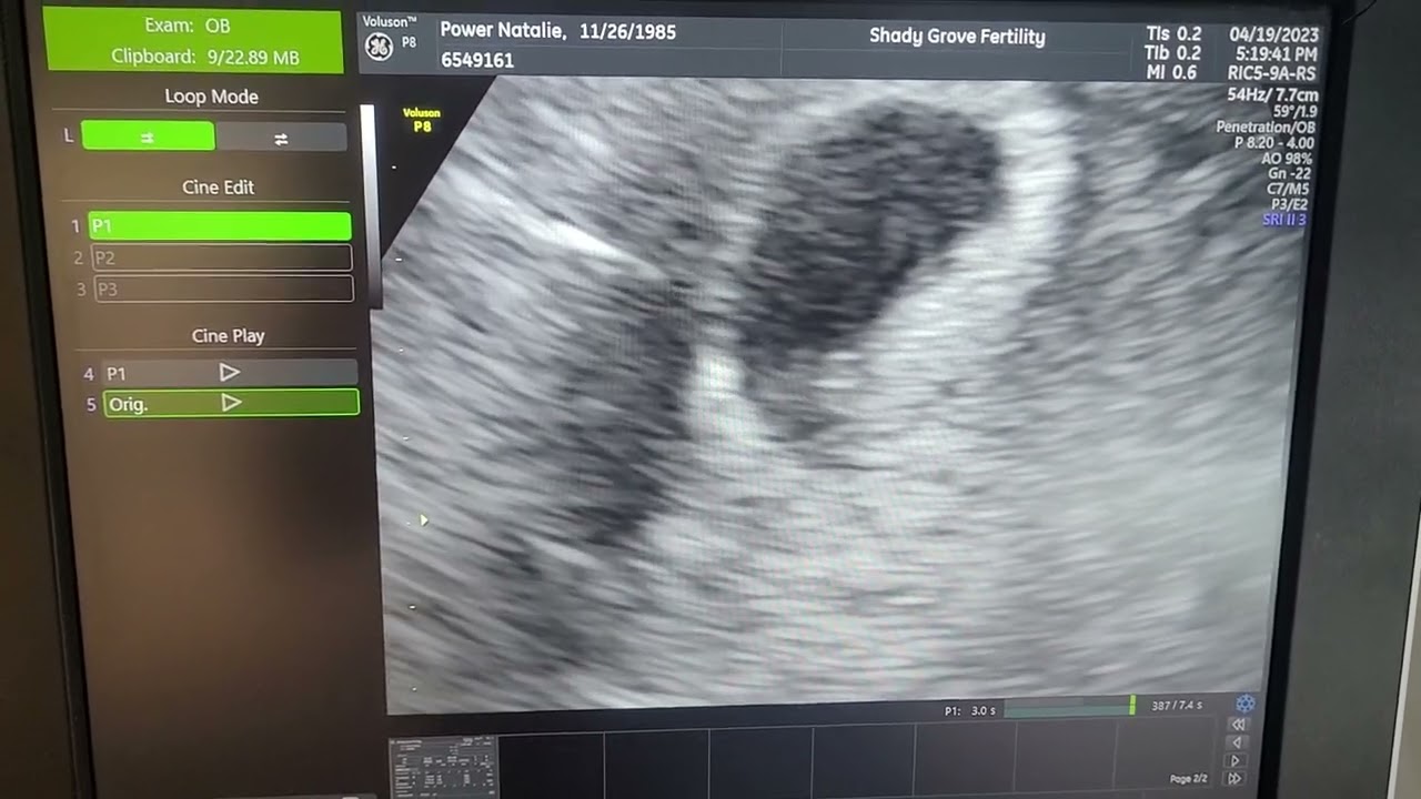 First Ultrasound