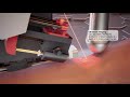 Robotics System | ASME Competition | Autonomous Vascular Access
