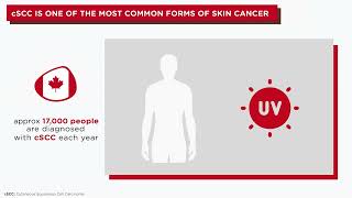 Helping you Understand cutaneous Squamous Cell Carcinoma