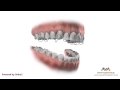 Orthodontic Retainer - Hawley - Instruction and Care