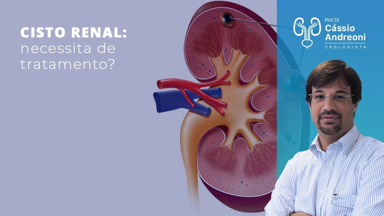 Cisto renal necessita de tratamento? Dr. Cassio Andreoni CRM 78.546 YouTube Cisto renal necessita de tratamento? Dr. Cassio Andreoni CRM 78.546 YouTube