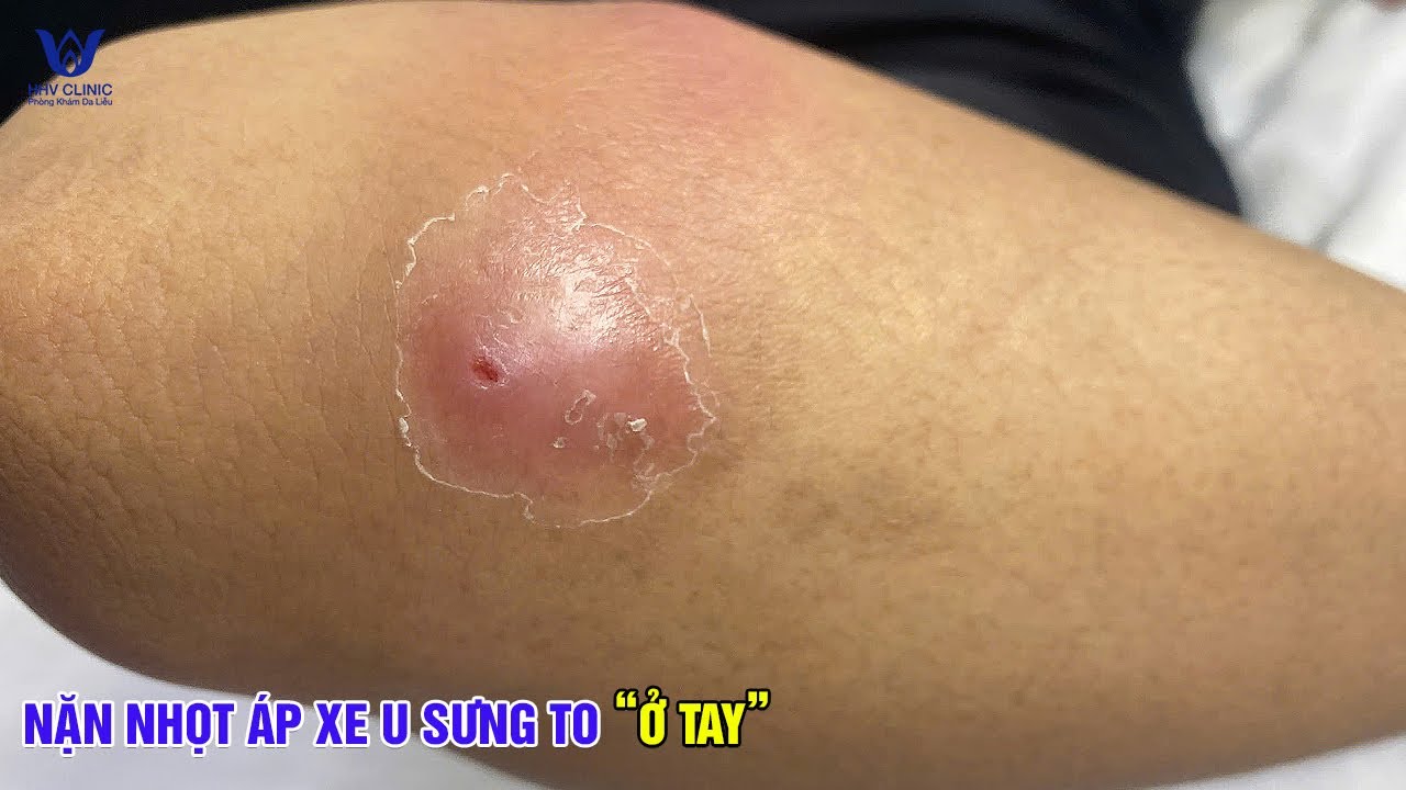 Điều trị mụn nhọt áp xe ở vùng cánh tay - Sưng viêm cứng nhiều dịch mủ.