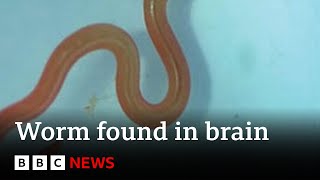 Live worm found in Australian woman's brain - BBC News