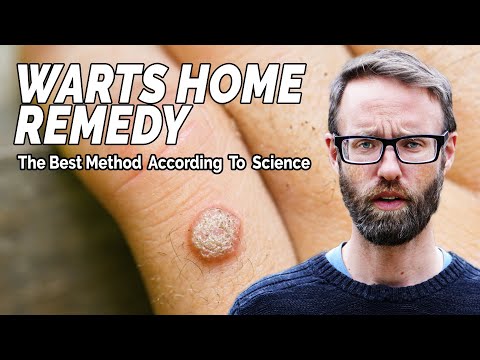 The Best Home Remedy For Warts - According to Research