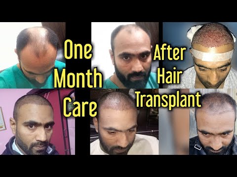 first-30-days-care-after-hair-transplant-|-1-month-day-by-day-care-and-precautions-for-best-result