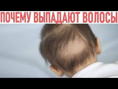 ВЫПАДЕНИЕ ВОЛОС У МЛАДЕНЦА | Почему выпадают волосы у маленьких детей Как избежать выпадения волос